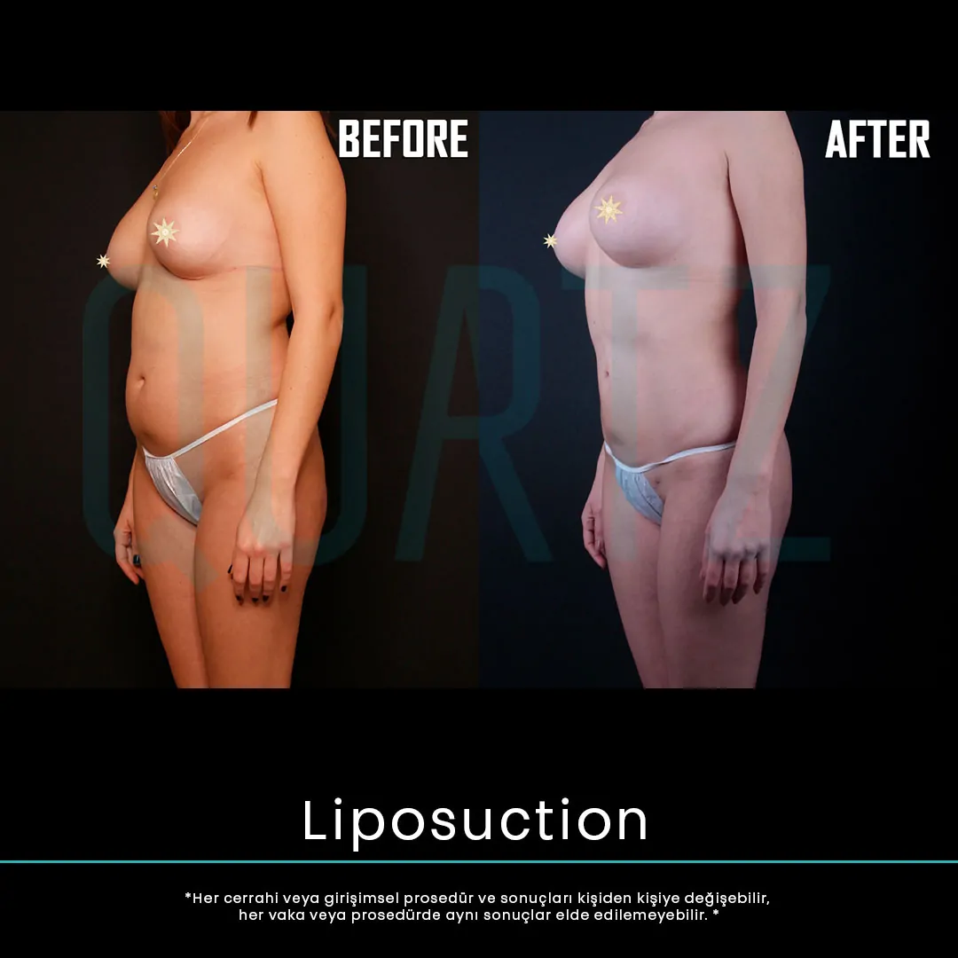 liposuction 21