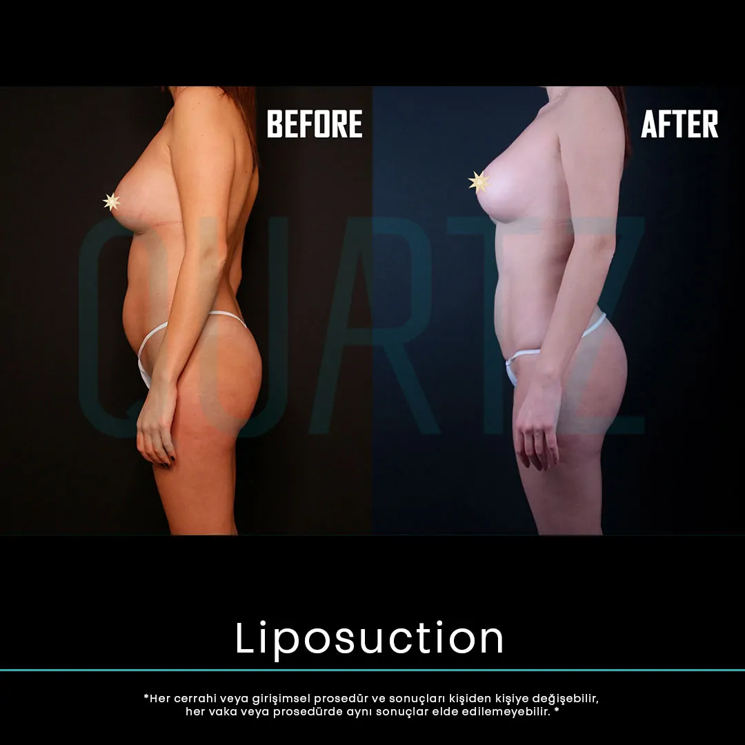 liposuction 22
