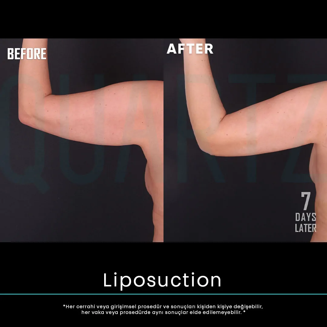 liposuction 4