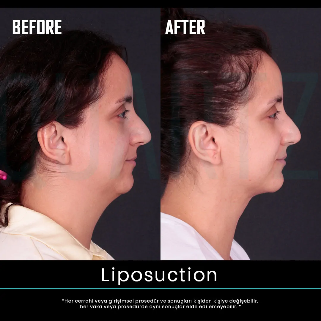liposuction 6